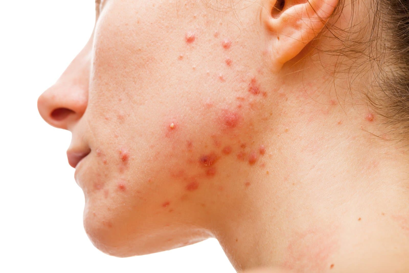 skin disease